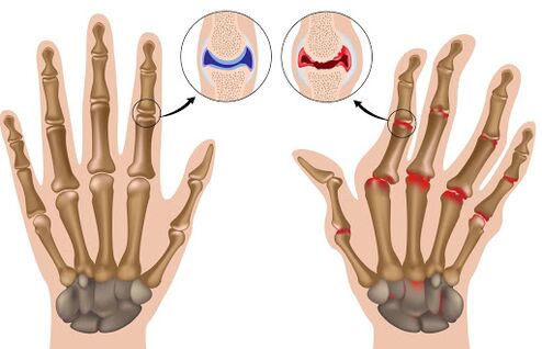 Arthritis disease and its manifestation. 