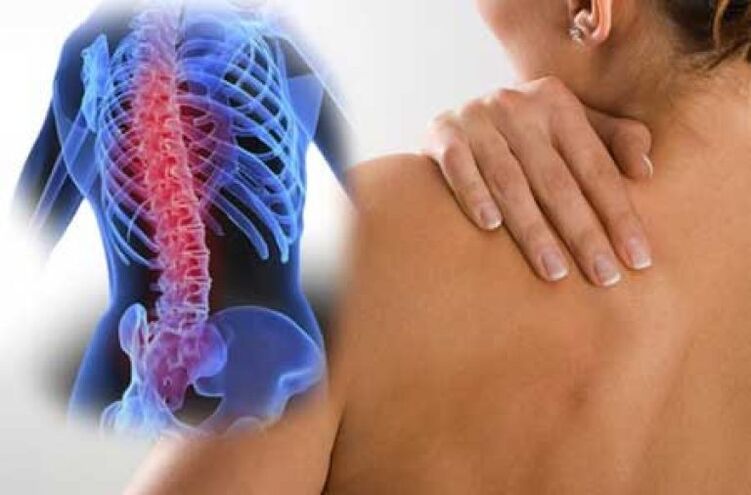During an exacerbation of osteochondrosis of the thoracic spine, pain occurs in the back. 