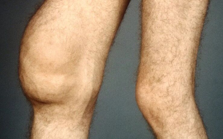 Post -trotrosis of the knee joint