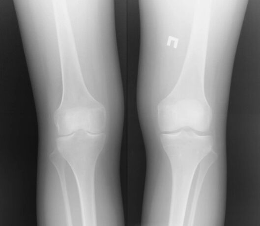The knee joint radiography