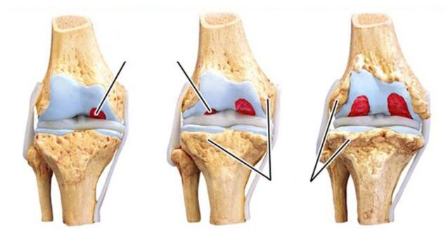 Complications of articulations osteoarthritis