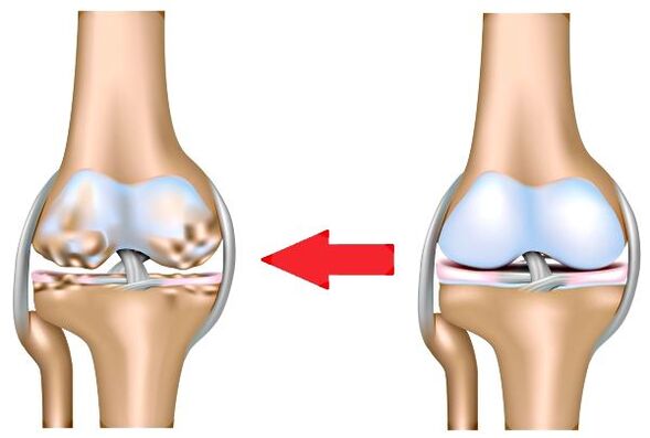 Healthy articulation and osteoarthritis