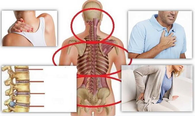 Disease places for osteochondrosis
