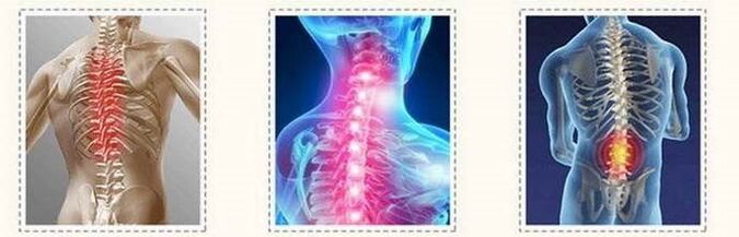 Spinal lesions of osteochondrosis