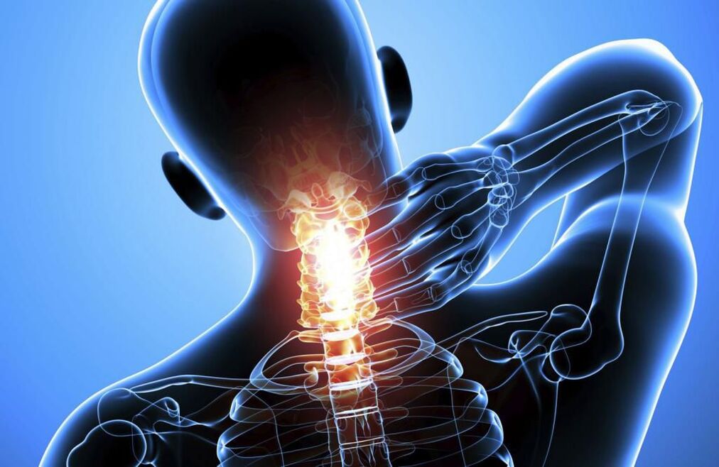 Osteochondrosis of the cervical spine.