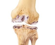 Damage to the knee joint due to osteoarthritis.