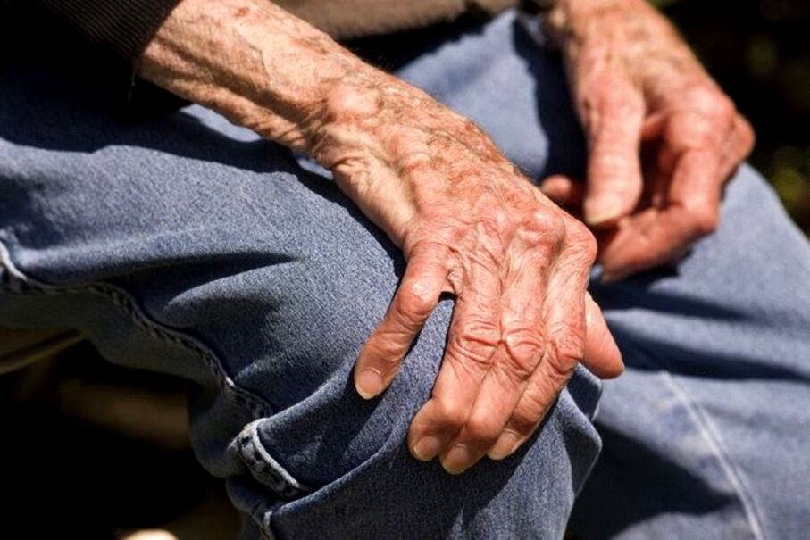 Osteoarthritis is an age-related disease that occurs in older people.