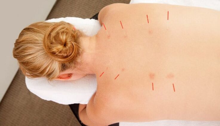 Acupuncture for thoracic osteochondrosis, which has many advantages.